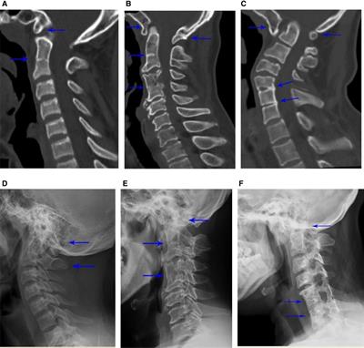 Prevalence and Risk Factors of Surgical Treatment for Klippel–Feil Syndrome